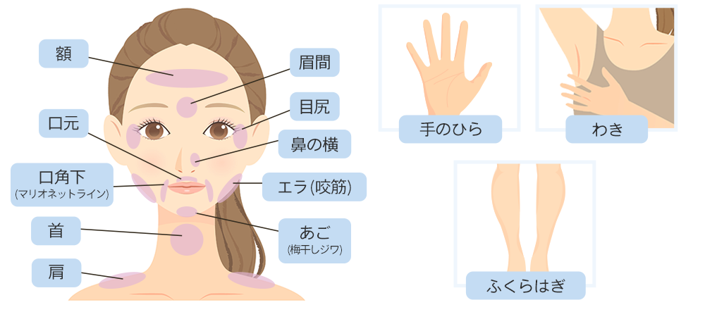 ボトックス注射